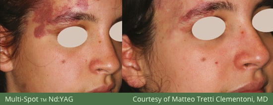 Before and After M22 Multi Spot Treatment