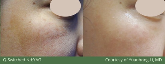 Before and After M22 Laser Skin MedSpa