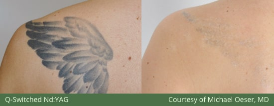 Before and After M22 Tatto Removal Treatment Laser Skin MedSpa