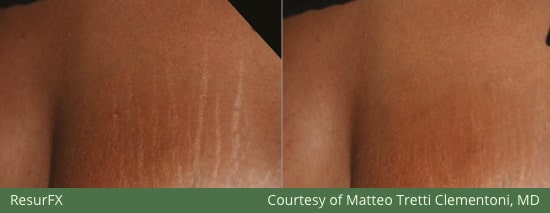 Before and After LaserSkin MedSpa