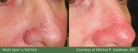 Before and After Multi Spot Laser Treatment