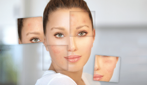 Acne Scar Treatments Laser Skin MedSpa