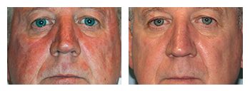Before and After Laser Skin Resurfx Treatment