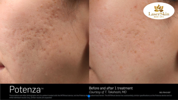 Before & After Problematic Skin Treatment
