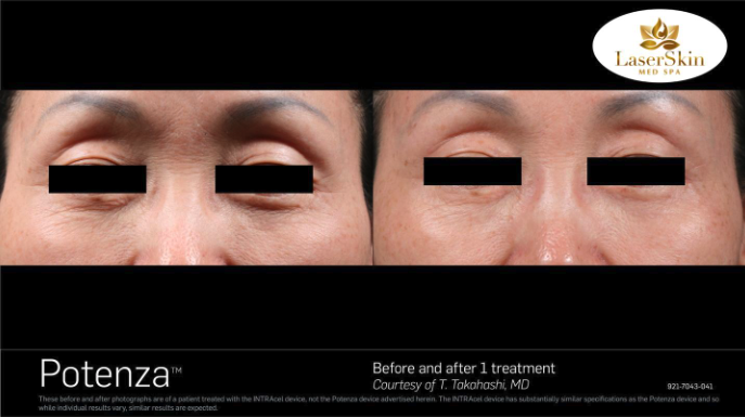 Before & After Skin Tightening Treatment