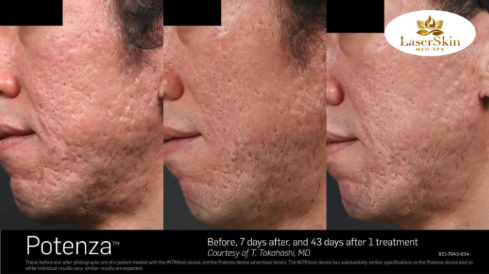 Before & After Problematic Skin Treatment