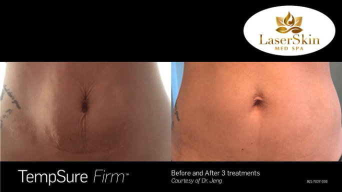 Before and After Laser Treatment