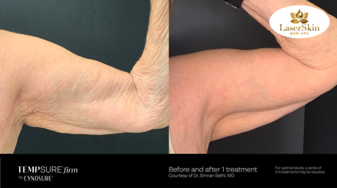 Before and After Body Tightening Treatment