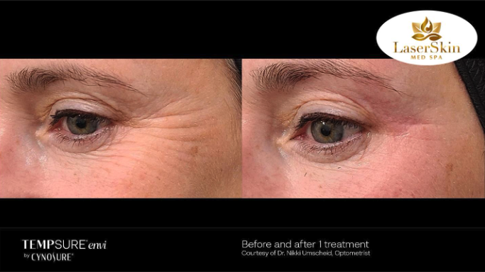 Before and After Skin Tightening Treatment