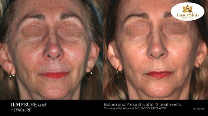 Before and After Skin Tightening Treatment