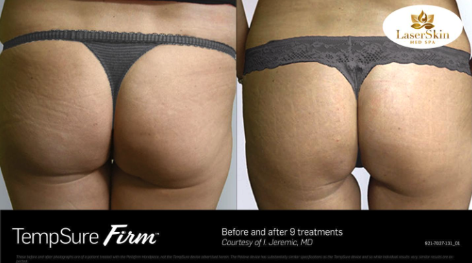 Before and After Stretch Marks Treatment