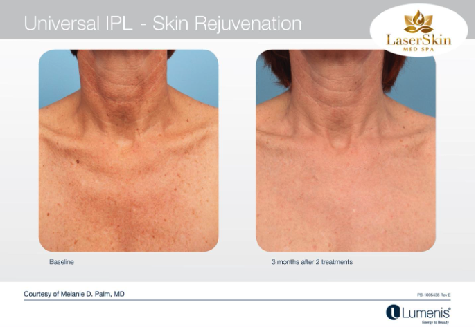Before and After IPL Treatment