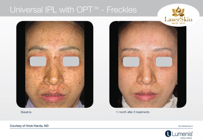 Before and After Pigmentation Treatment
