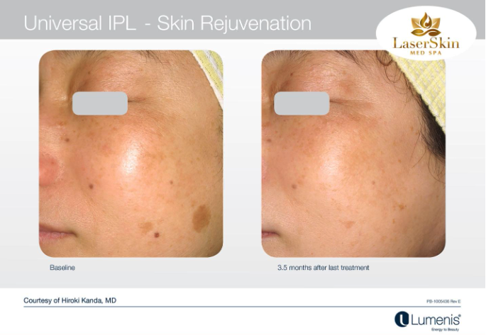 Before and After Skin Rejuvenation Treatment