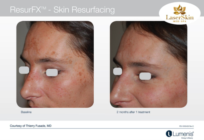 Before and After Skin Resurfacing Treatment