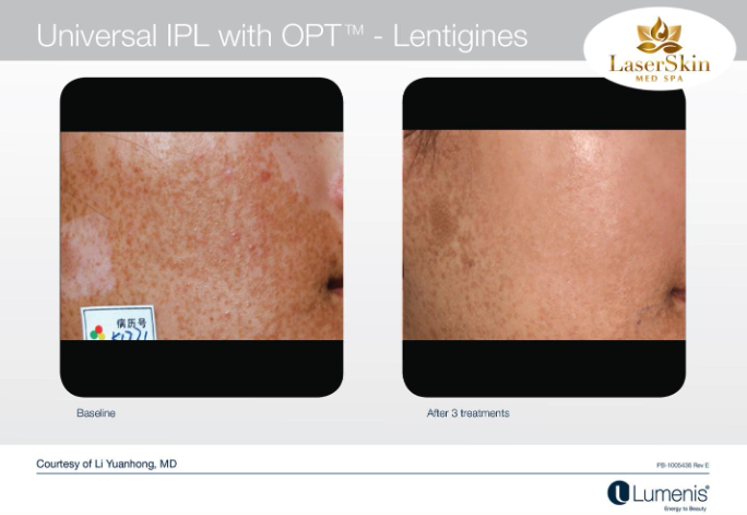 Before and After IPL Sun Damage & Pigmentation