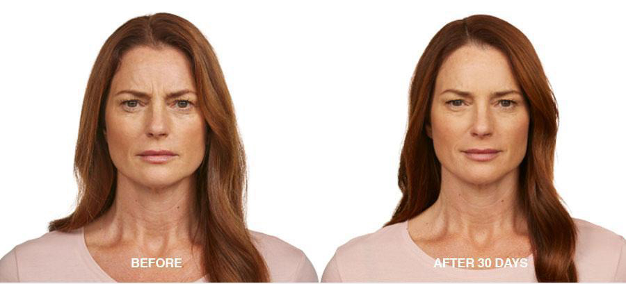 Before and After Skin Tightening Treatment - LaserSkin MedSpa