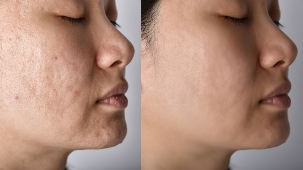 RF Skin Tightening Treatments - Skin Damage - LaserSkin MedSpa