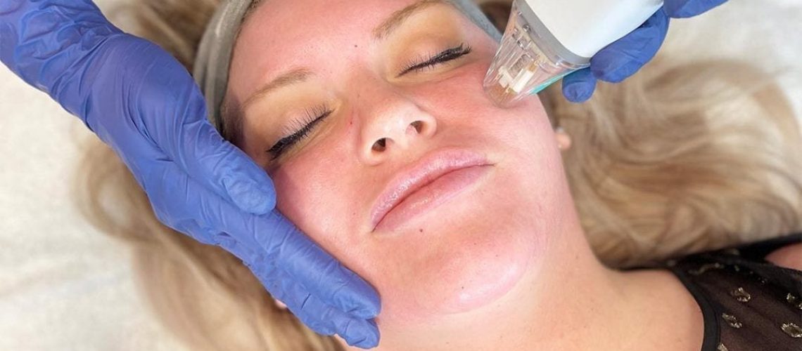 7-things-you-should-know-about-potenza-rf-microneedling-1080x675