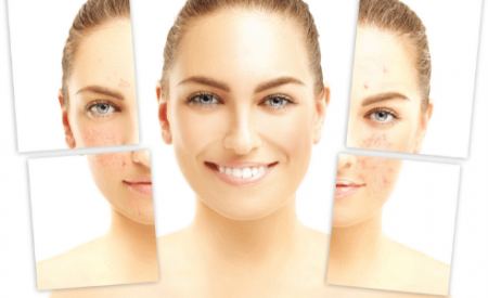 Rosacea Acne Treatments Laser Skin MedSpa