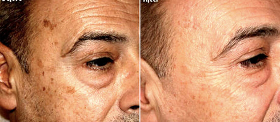 Before and After IPL Treatment