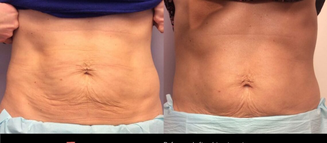 TempSure RF - Before and After Skin Tightening Treatment