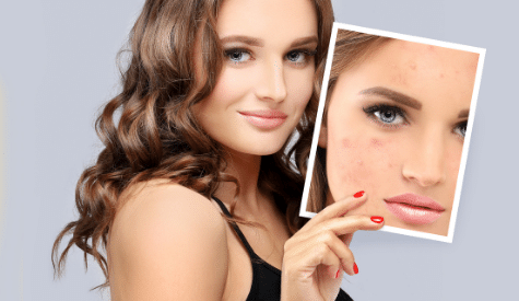 Acne Removal Treatments