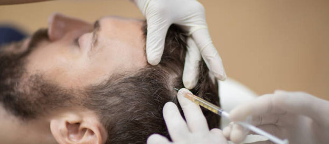 Hair mesotherapy or scalp prp: Platelet-rich plasma procedure. Beautician doctor makes injections in the man head for hair growth against hair loss and baldness